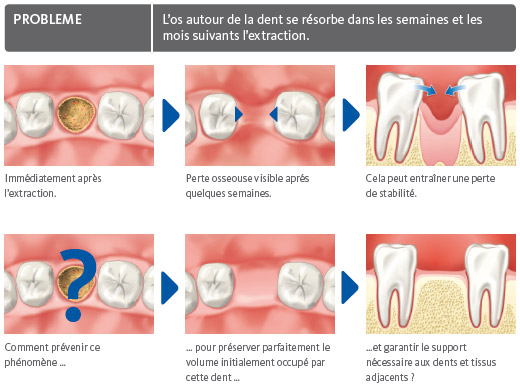 Extraction dentaire : quand, durée, déroulé, soins après