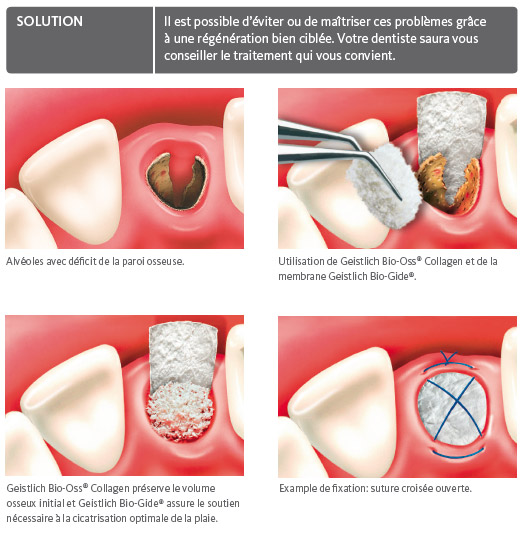 Extraction dentaire : quand, durée, déroulé, soins après