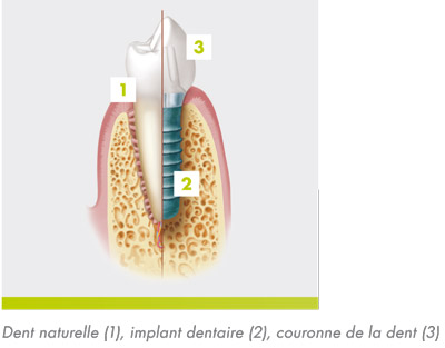 implantologie2