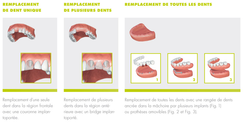 implantologie3